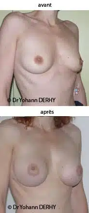 photo augmentation mammaire par prothèse anatomique