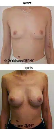 augmentation mammaire : implant anatomique