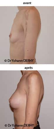 augmentation mammaire : implant anatomique