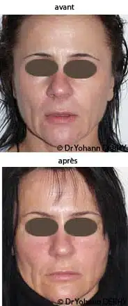 photos botox (toxine botulique) sourcil
