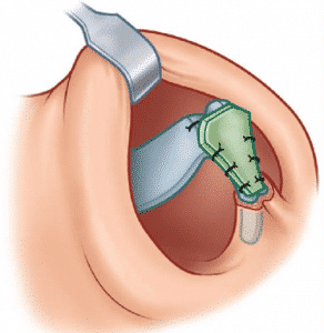 greffe de cartilage pour augmenter la projection de la pointe du nez