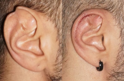photos de reduction de l'oreille par plastie d'antia-busch
