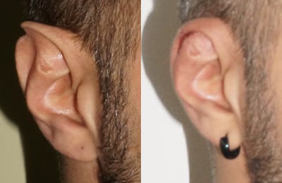 photos de reduction de l'oreille par plastie d'antia-busch