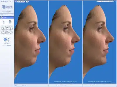 consultation pour rhinoplastie avec simulation 3D