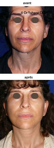 photo lifting visage et cou, botox, lift temporal