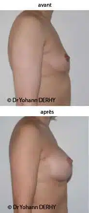 photo augmentation sein par prothèse mammaire