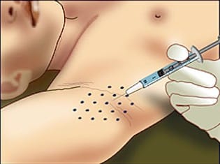 injection de botox pour hyperhydrose axillaire