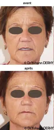photo acide hyaluronique visage