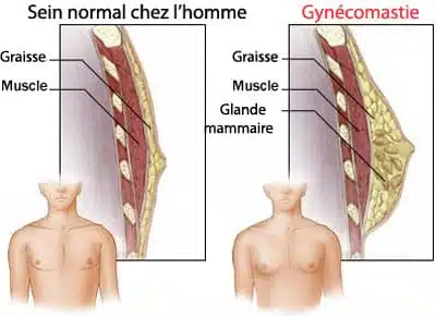 anatomie de la gynécomastie