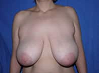hypertrophie mammaire