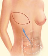 reconstruction mammaire TRAM