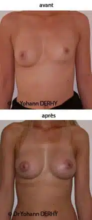 photo augmentation mammaire par prothèse et asymétrie