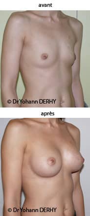 photo augmentation mammaire par prothèse anatomique
