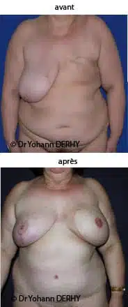 photo reconstruction mammaire diep