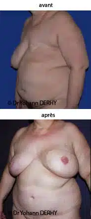 photo reconstruction mammaire diep