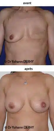 photo reconstruction mammaire prothèse