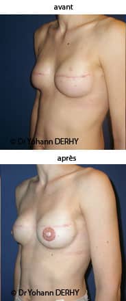 photo reconstruction mammaire prothèse