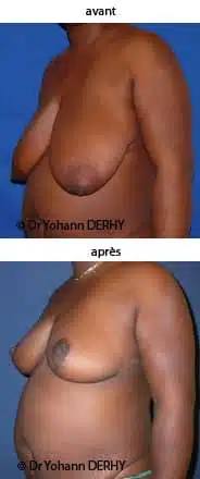 photo hypertrophie mammaire