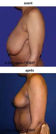 photo hypertrophie mammaire