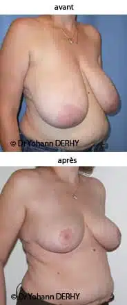 photo réduction mammaire
