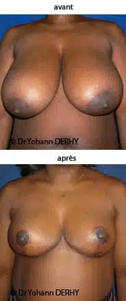 photo reduction mammaire