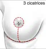 cicatrice en T pour réduction mammaire