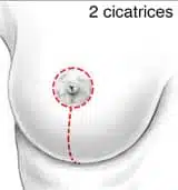 cicatrice verticale pour reduction mammaire