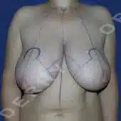 dessin reduction mammaire avant intervention