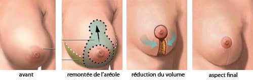 principe de la réduction mammaire
