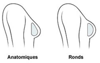 augmentation mammaire anatomique ou ronde