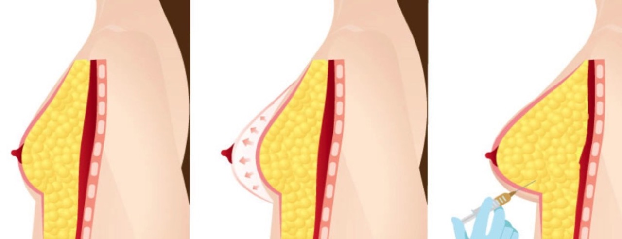 augmentation mammaire par lipofilling mammaire