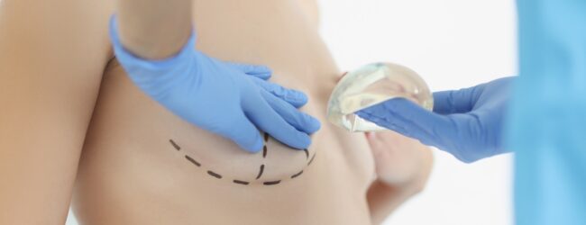 ptose mammaire et augmentation mammaire par implant