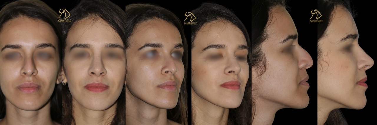 Photos avant et après une rhinoplastie vue de face, 3/4 et de profil par le Dr Derhy