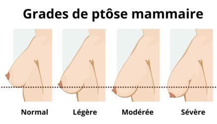 Classification de la ptôse mammaire