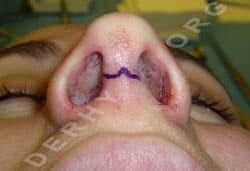 rhinoplastie ouverte incision v